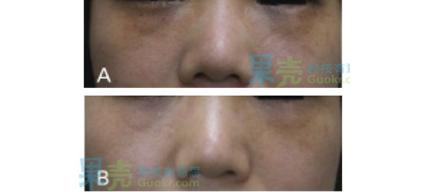 血管型黑眼圈治疗_黑眼圈成因类型_去除黑眼圈