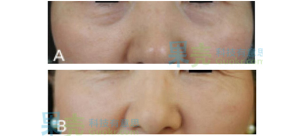 去除黑眼圈_黑眼圈成因类型_血管型黑眼圈治疗