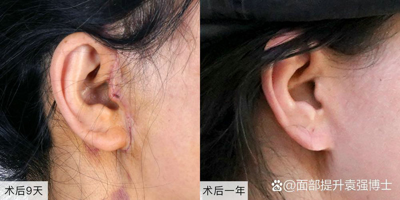 做人流手术的5大危害