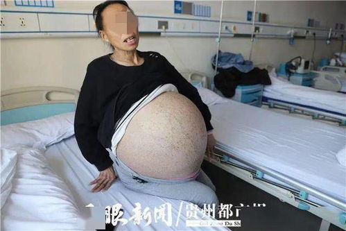 无痛人流后怎么做的 无痛人流后怎么做的快一点