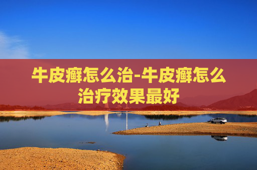 牛皮癣怎么治-牛皮癣怎么治疗效果最好