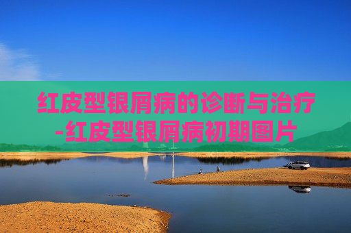 红皮型银屑病的诊断与治疗-红皮型银屑病初期图片 红皮型银屑病的诊断与治疗-红皮型银屑病初期图片