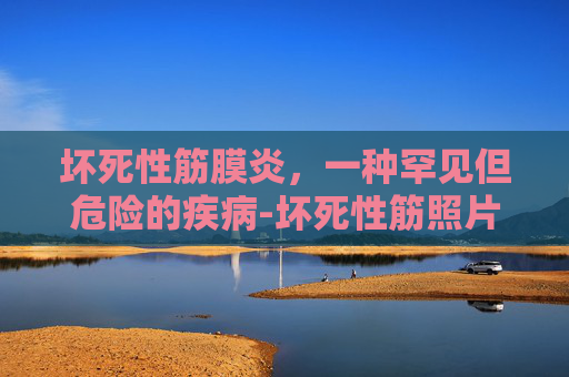 坏死性筋膜炎，一种罕见但危险的疾病-坏死性筋照片图片