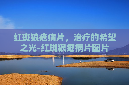 红斑狼疮病片，治疗的希望之光-红斑狼疮病片图片